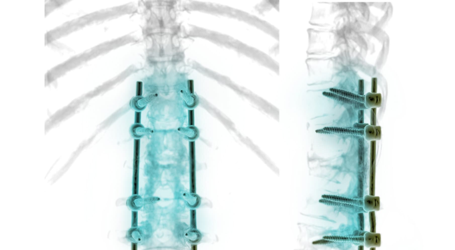 Cervical spine implant illustration